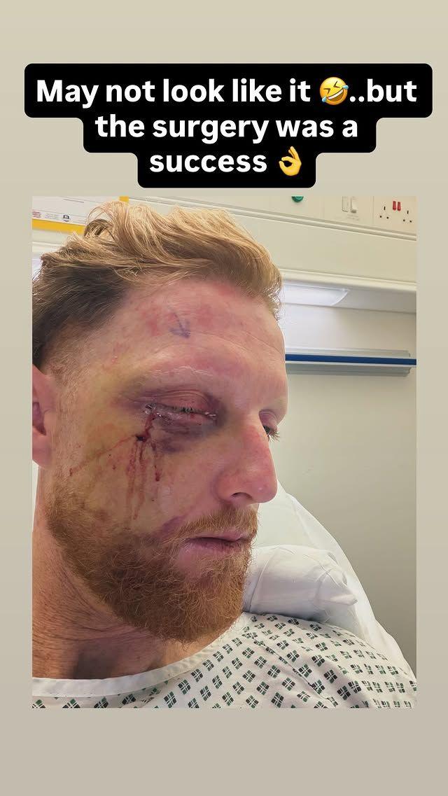Ben Stokes: England Test captain has surgery on broken cheek